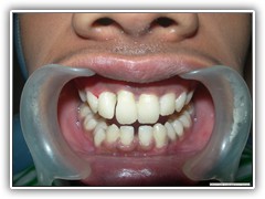 Best dental implant centre in bhopal